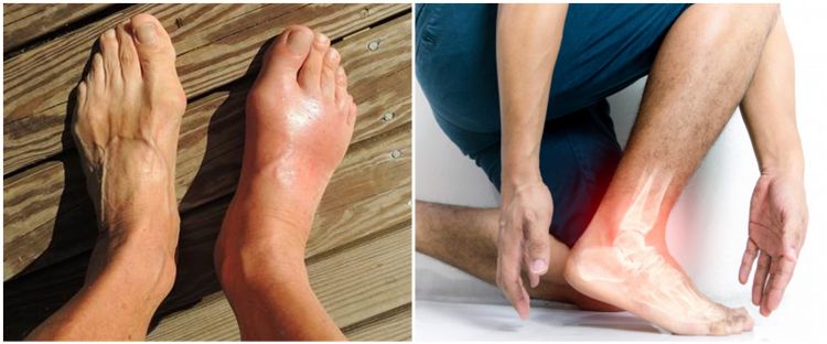 8 Common Characteristics Of Uric Acid Prevent Early Netral News