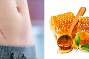 10 Cara menghilangkan keloid secara alami, mudah dan aman dilakukan