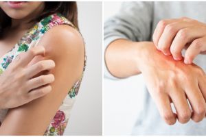 5 Tanaman obat gatal kulit, aman dan ampuh atasi iritasi