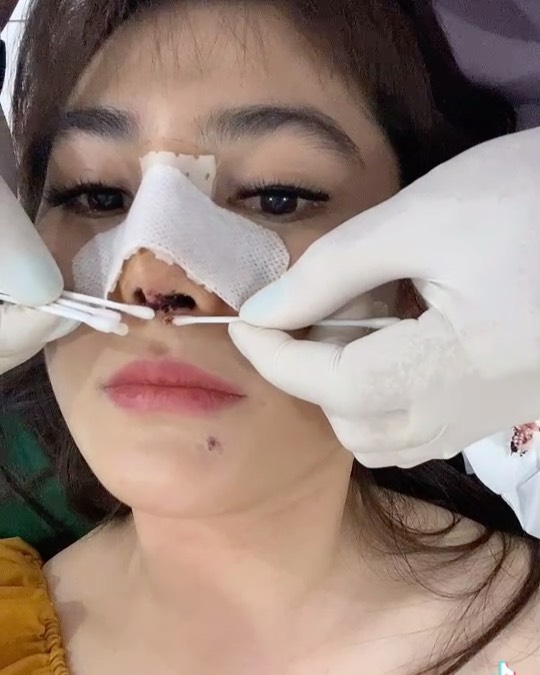 8 Potret terbaru Angela Lee usai operasi hidung, parasnya manglingi