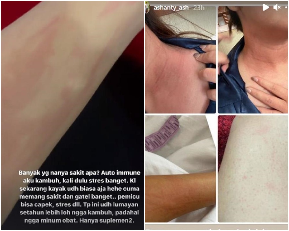 Ashanty sakit jelang pernikahan Aurel Hermansyah, autoimun kambuh