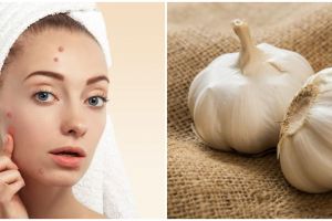 Mitos atau fakta, bawang putih bisa menghilangkan jerawat?