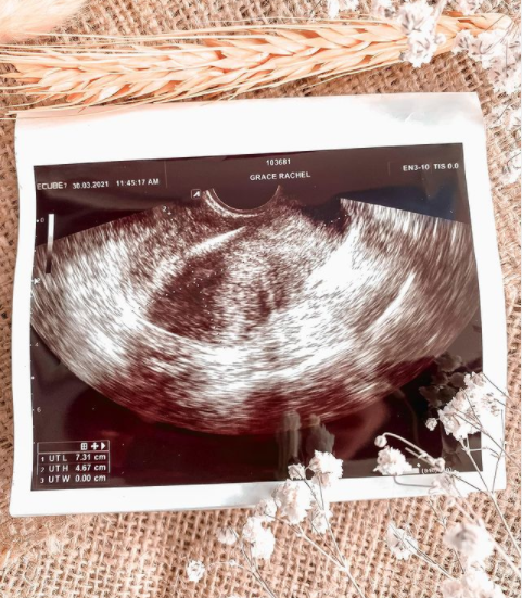 15 Cerita Rachel Goddard berjuang lawan kista, terpaksa angkat rahim