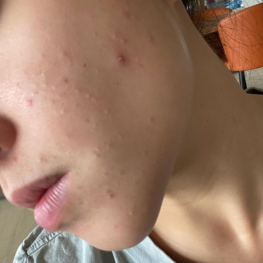 7 Potret perubahan wajah Nikita Willy saat berjerawat