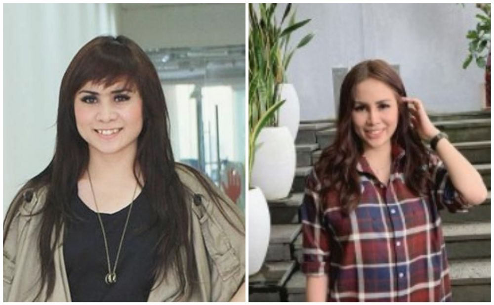 Beda penampilan 11 seleb sebelum & sesudah filler, ada yang awet muda