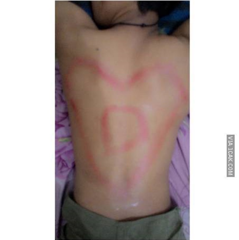 20 Potret orang kerokan hasilnya bikin nyengir kuda