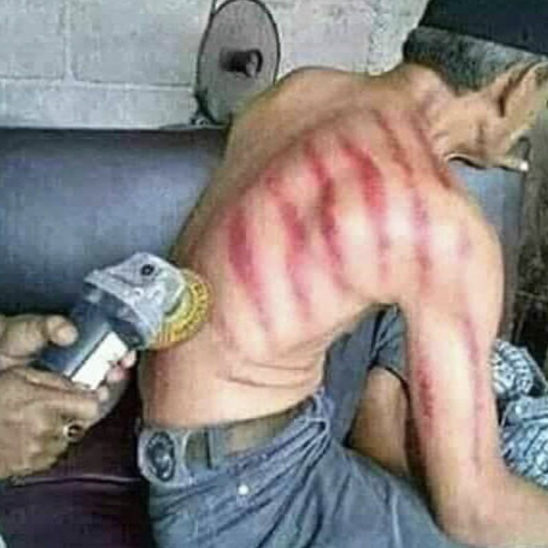 20 Potret orang kerokan hasilnya bikin nyengir kuda