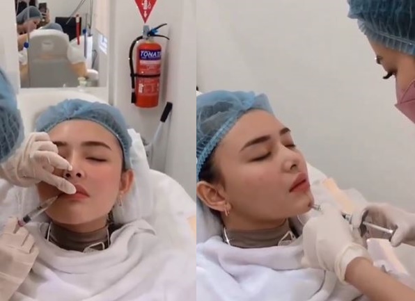 5 Potret perubahan wajah Amanda Manopo usai suntik bibir dan dagu