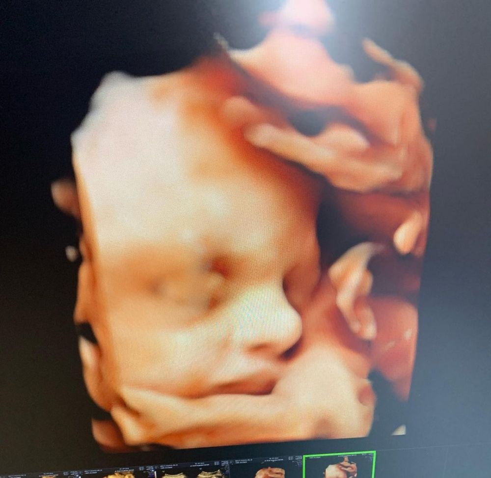 Nella Kharisma unggah foto USG, wajah sang bayi curi perhatian