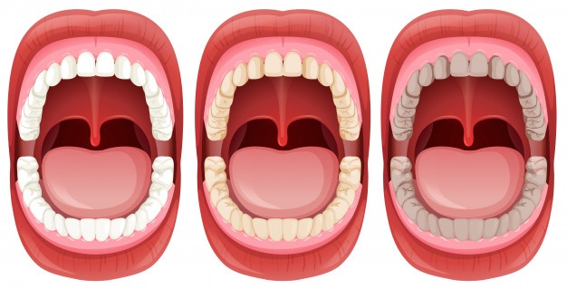 7 Penyebab munculnya karang gigi dan cara alami mengatasinya