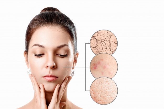11 Penyebab kulit berminyak dan cara alami mengatasinya
