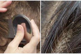 10 Cara menghilangkan kutu rambut, cepat dan aman dilakukan