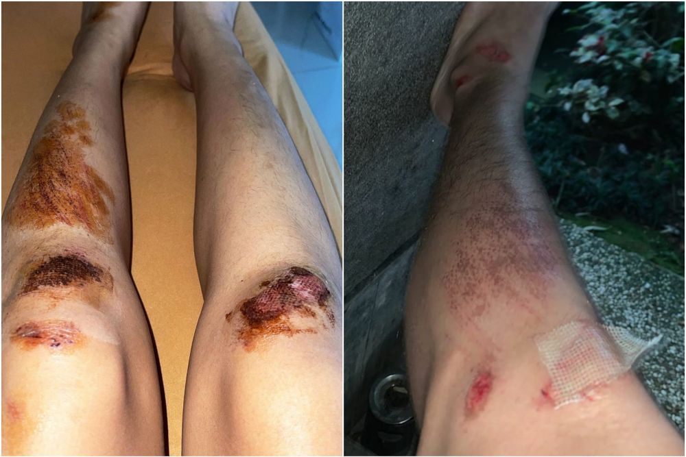 7 Potret kondisi Brisia Jodie dan Julian Jacob usai kecelakaan otopet