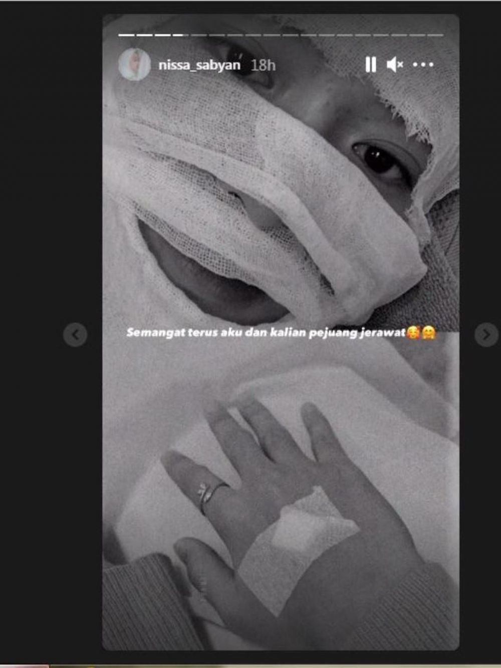 Unggah foto wajah diperban, kondisi Nissa Sabyan jadi sorotan
