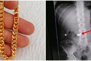 Pencuri di India ini nekat telan potong rantai emas agar tak ketahuan