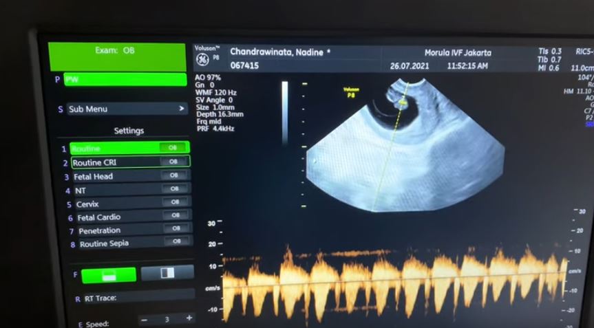 Dengarkan detak jantung janin, respons Dimas Anggara bikin ketawa