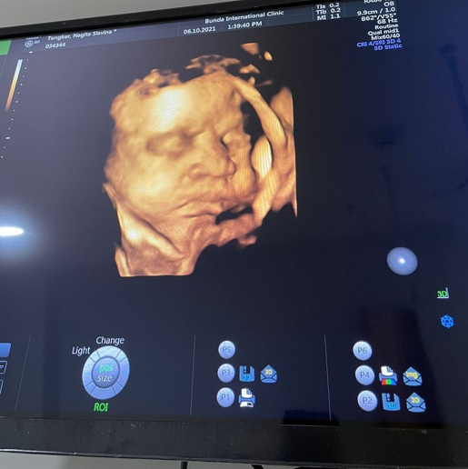 Nagita unggah USG terbaru, paras calon bayi disebut mirip Rafathar