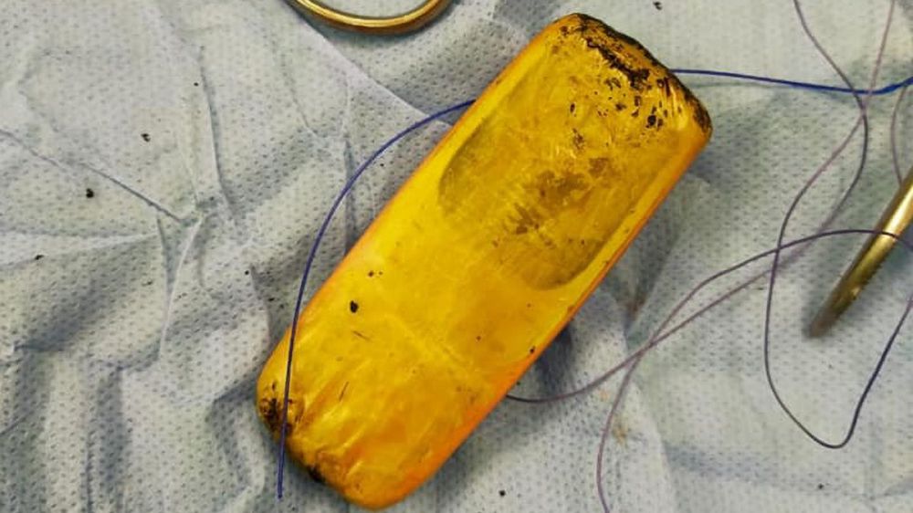 Dokter temukan ponsel Nokia 3310 di perut pasien, tertelan 6 bulan