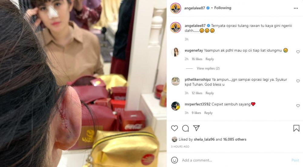 Nyesel operasi hidung sampai implan jebol, begini kondisi Angela Lee