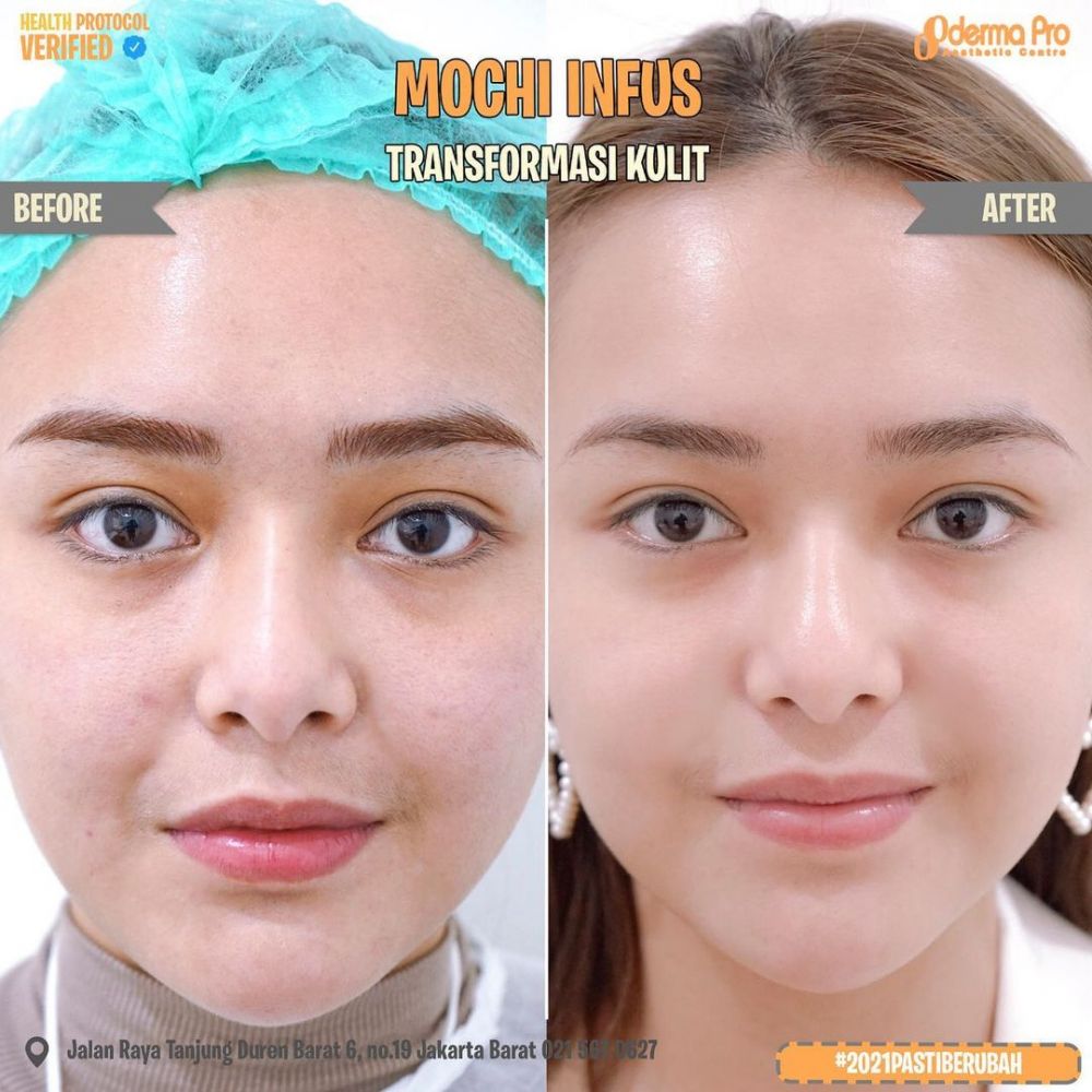 Potret perbedaan wajah Amanda Manopo sebelum dan usai perawatan