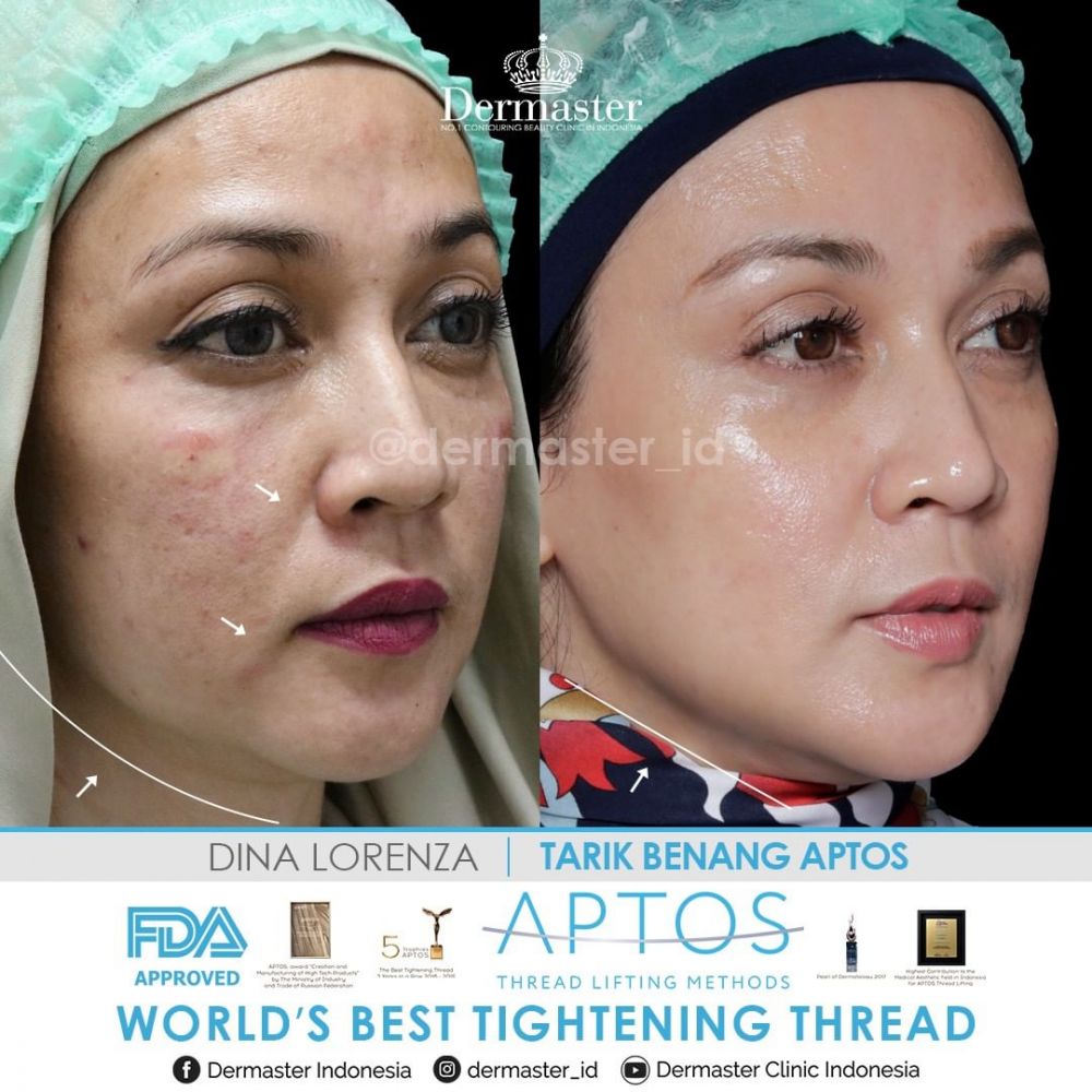 Beda penampilan 9 seleb usia 40-an sebelum dan sesudah tanam benang