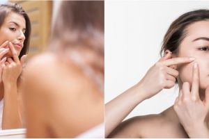 11 Cara menghilangkan panu di wajah pakai bahan alami, mudah dan cepat