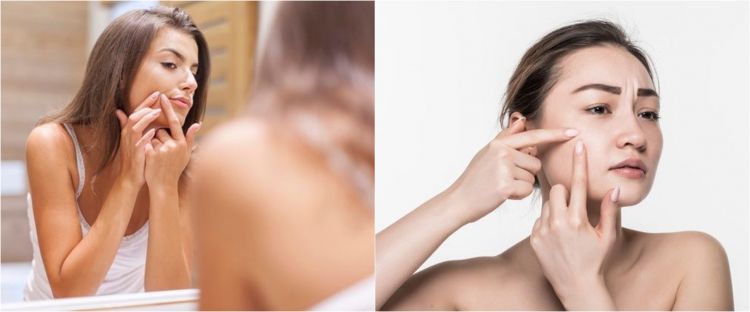 11 Cara menghilangkan panu di wajah pakai bahan alami, mudah dan cepat