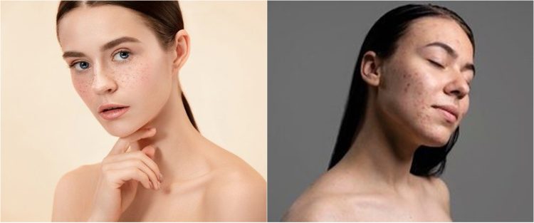 11 Rekomendasi skincare menghilangkan flek hitam & cara menggunakannya