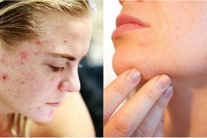 9 Cara menghilangkan bekas luka di wajah, aman dan mudah dibuat
