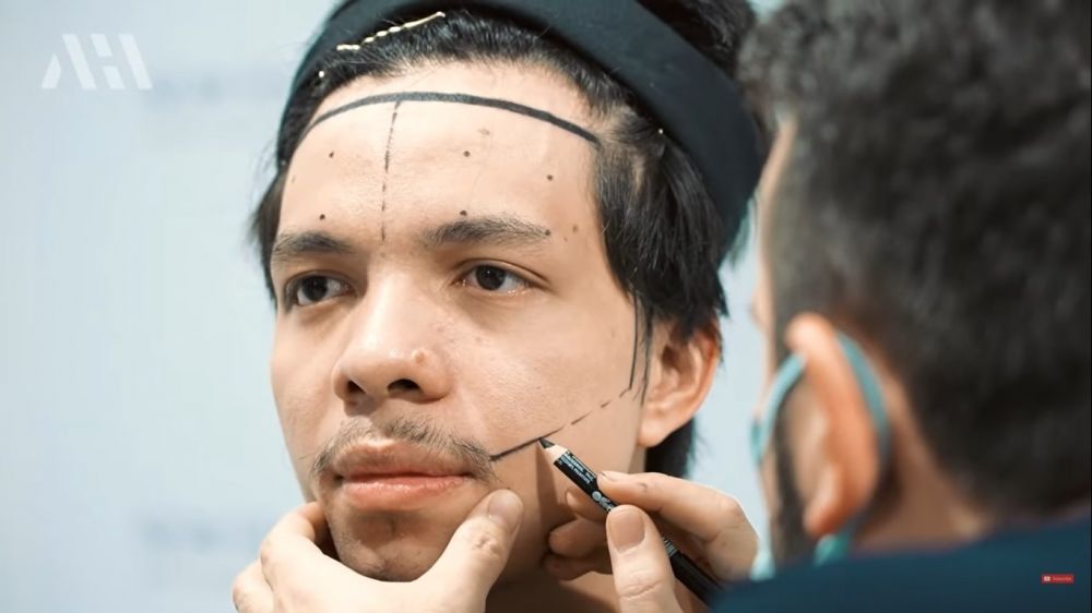 Tak pede berjidat lebar, 9 potret Atta Halilintar transplantasi rambut