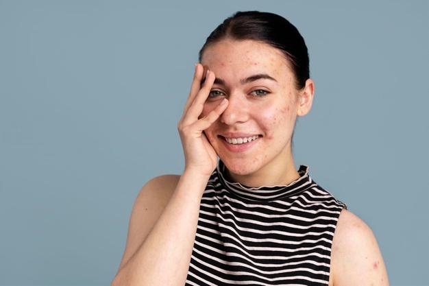 10 Manfaat kunyit untuk wajah, mampu atasi jerawat