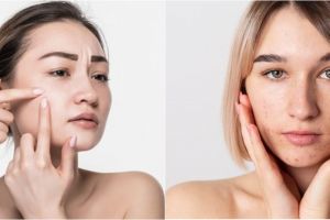 9 Rekomendasi serum untuk beruntusan, bikin wajah mulus