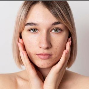 11 Cara mengatasi wajah bruntusan akibat skincare dengan bahan alami
