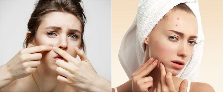 9 Rekomendasi skincare penghilang jerawat, mulus tanpa bekas