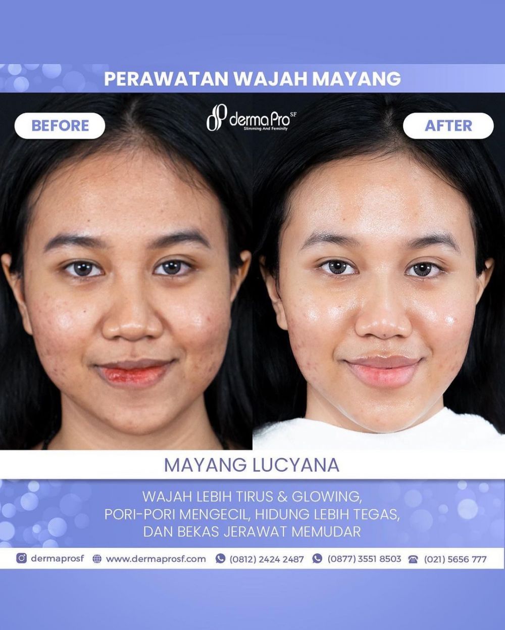 7 Potret Mayang sebelum dan sesudah perawatan wajah, habis Rp 80 juta