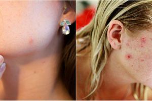 9 Rekomendasi skincare untuk wajah berjerawat, ada masker hingga serum