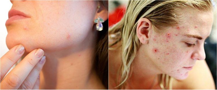 9 Rekomendasi skincare untuk wajah berjerawat, ada masker hingga serum