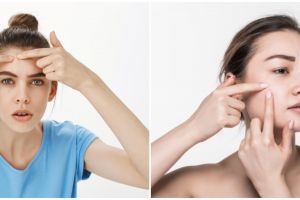 11 Cara menghilangkan milia di wajah secara alami, mudah diaplikasikan