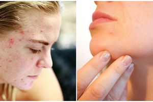 Rekomendasi 11 skincare untuk kulit berjerawat dan berminyak