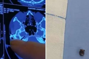 Mengeluh sering sakit, ternyata ada peluru di kepala selama 20 tahun