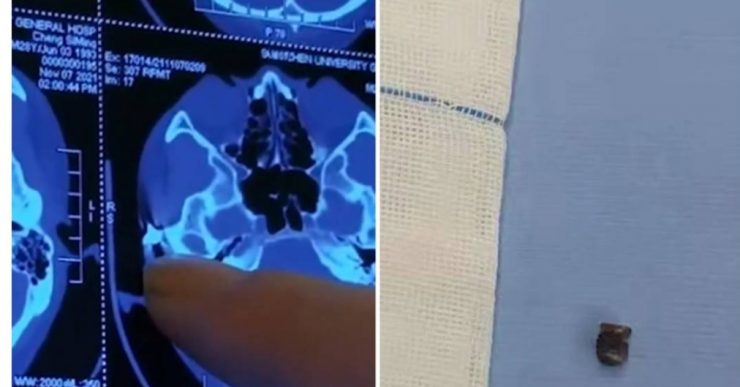 Mengeluh sering sakit, ternyata ada peluru di kepala selama 20 tahun