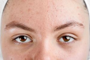 15 Rekomendasi skincare hilangkan milia harga mulai Rp 20 ribu, wajah jadi mulus dan bebas gradakan
