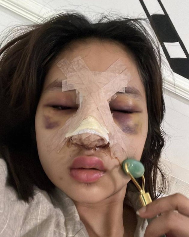 Alami efek samping usai oplas, ini 9 foto terbaru putri Farida Nurhan