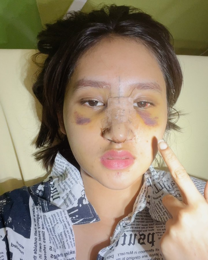 Alami efek samping usai oplas, ini 9 foto terbaru putri Farida Nurhan