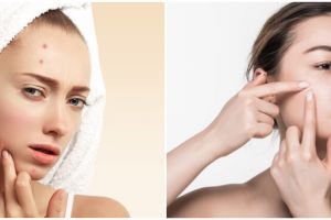 9 Kandungan skincare untuk kulit berjerawat, wajib dicoba
