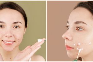 9 Tips hilangkan wajah bopeng, kulit kembali mulus