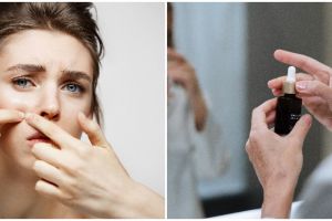 9 Manfaat niacinamide untuk wajah, membantu menyamarkan noda hitam