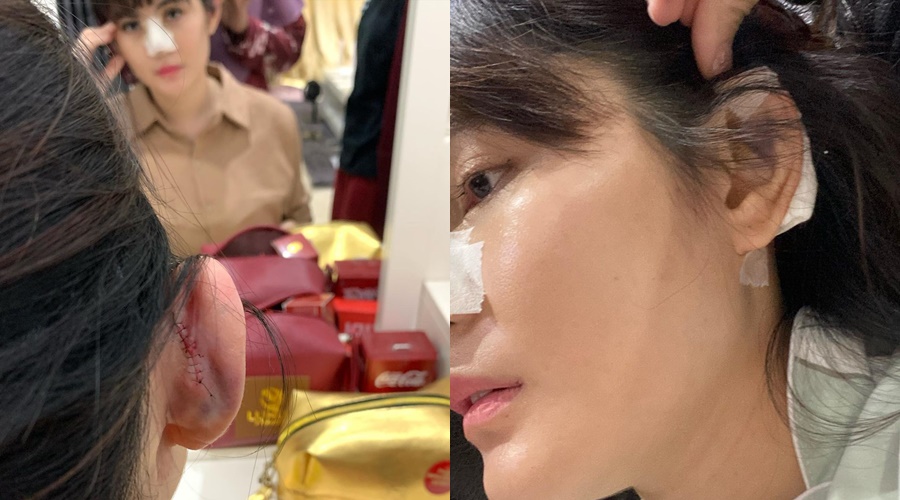 Beda penampilan 12 seleb usai operasi hidung, ada habiskan Rp 50 juta