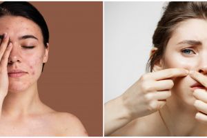 15 Produk skincare untuk kulit berjerawat, harga di bawah Rp 150 ribu