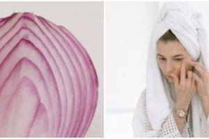 7 Manfaat bawang merah untuk wajah, atasi jerawat meradang